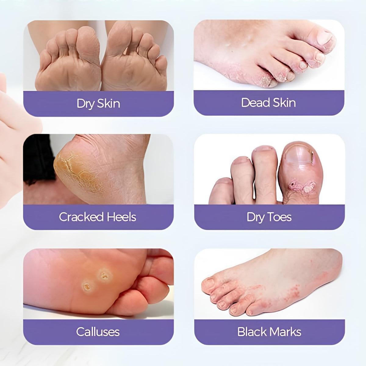 Foot Peeling Mask (1 Pair), Korean Peeling & Exfoliating with Glycolic Acid, Removes Dead Skin, Cruelty-Free, Goat Milk Foot Mask for Deep Exfoliation and Moisturizing